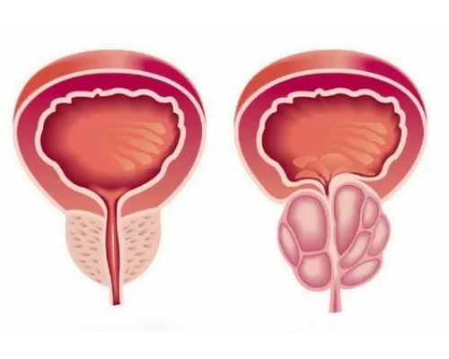 Enlarged Prostate Treatment: Effective Solutions for BPH