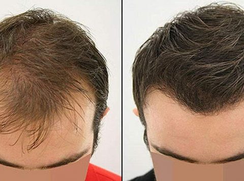 Hair Transplant in Dubai